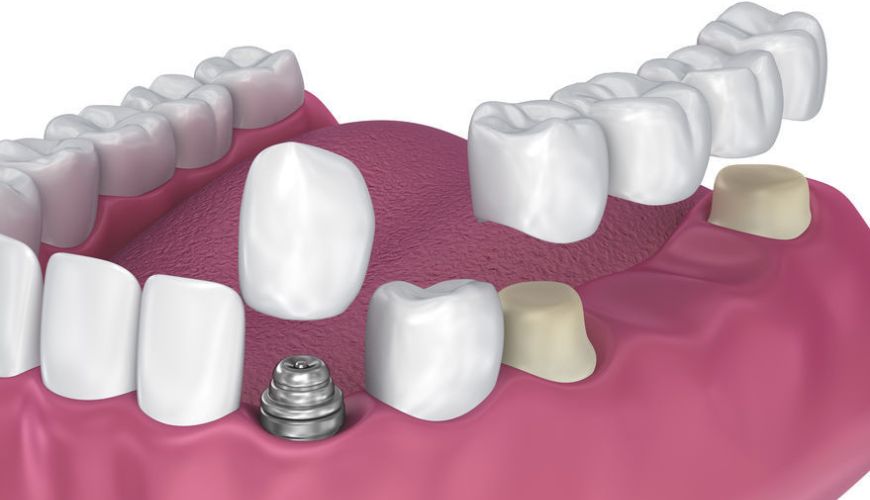 Crowns & Bridge Treatment