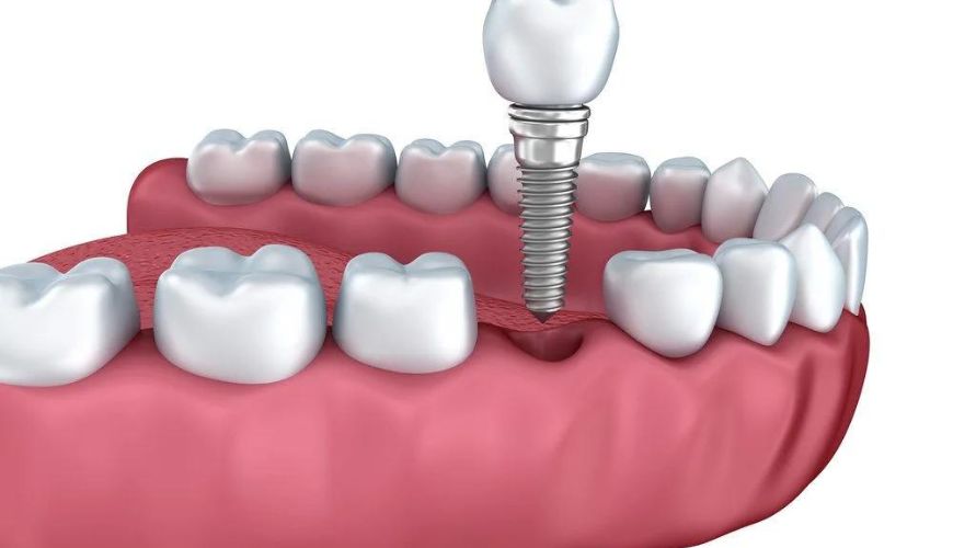 Dental Implants Treatment