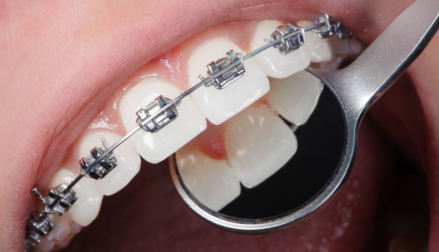 Orthodontics Treatment In Chembur