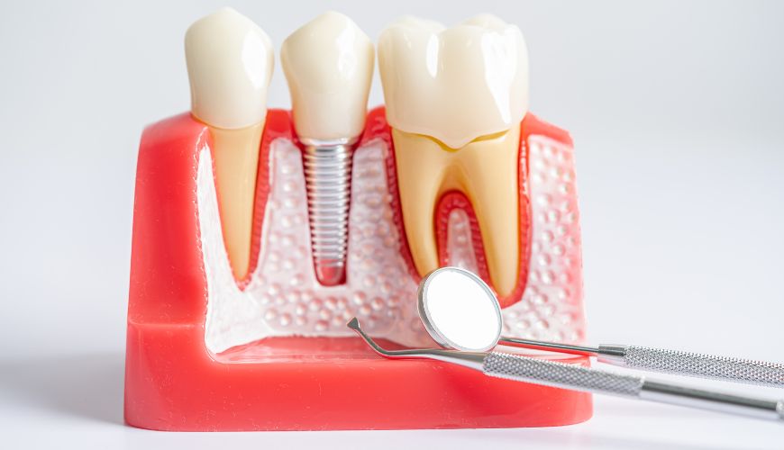 Root canal treatment